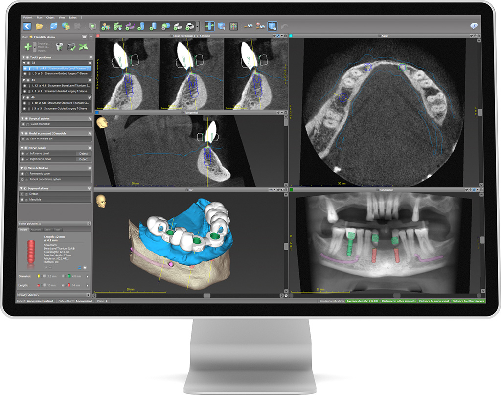 3D-Planung für Implantate
